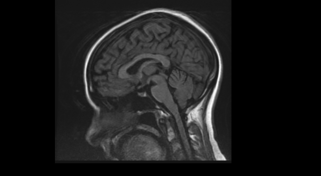 An MRI image of the brain